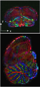 Color Coded diffusion tensor imaging (DTI)